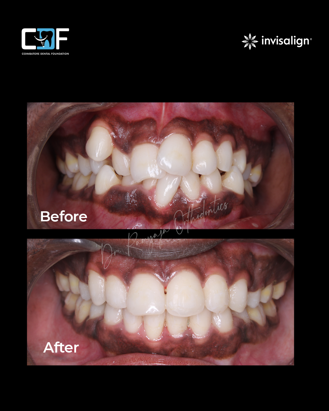 Before After Result